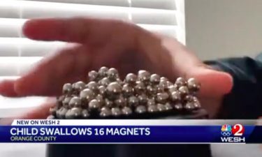 2-year-old is hospitalized after swallowing 16 magnetic balls.