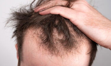 Male-pattern baldness affects most men at one point in their lives.