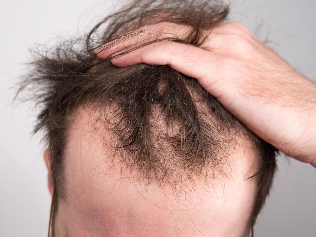 <i>Adobe Stock</i><br/>Male-pattern baldness affects most men at one point in their lives.