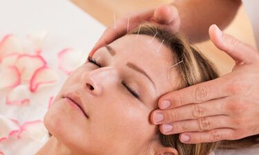 People who have chronic tension headaches could find sustained relief with the help of acupuncture treatments.