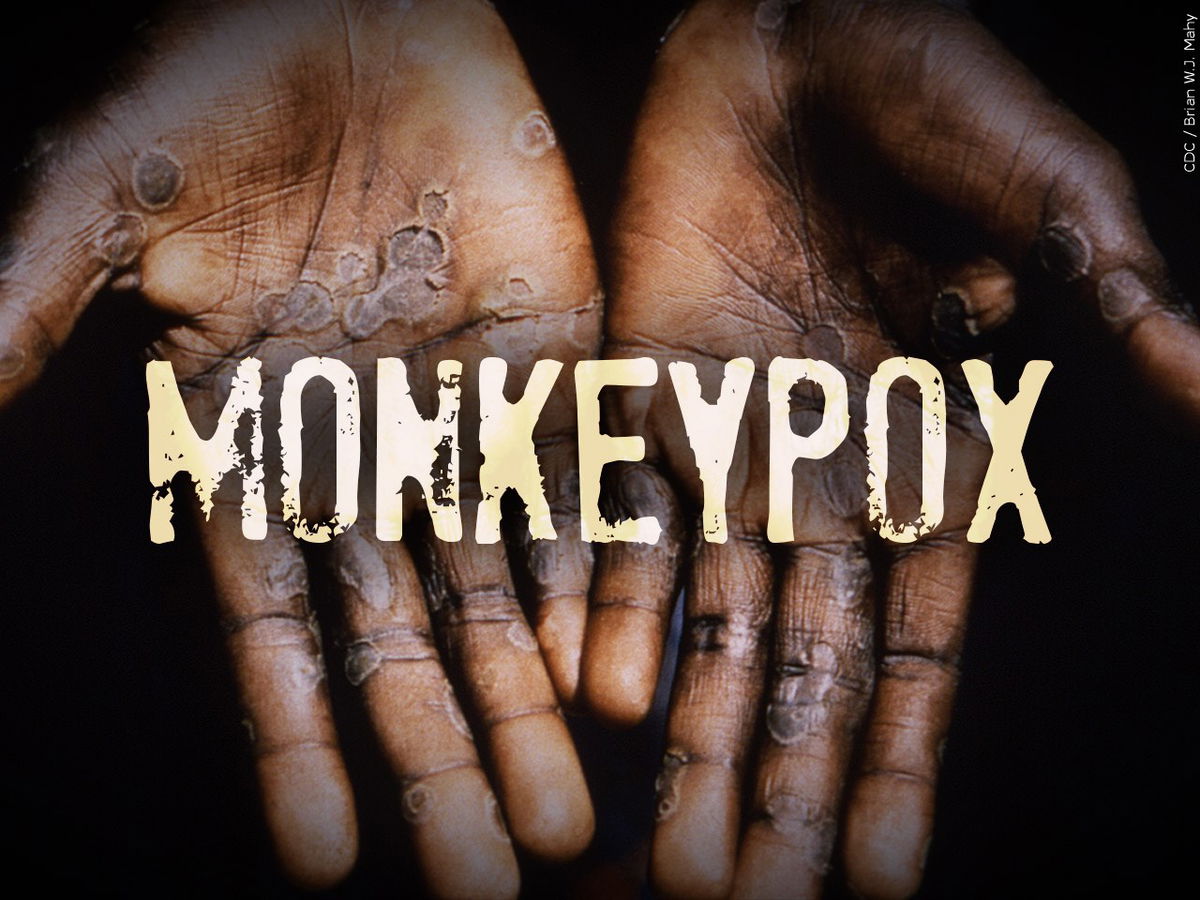 California Announces Arrival of 72,000 Doses of Monkeypox Vaccine – KION546