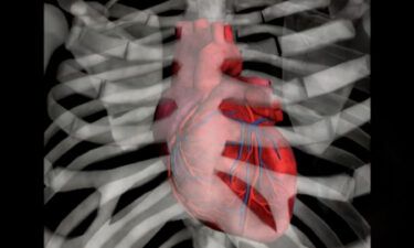 Cardiologists say an inexpensive polypill is probably one of the best ways to solve the world's heart problems.