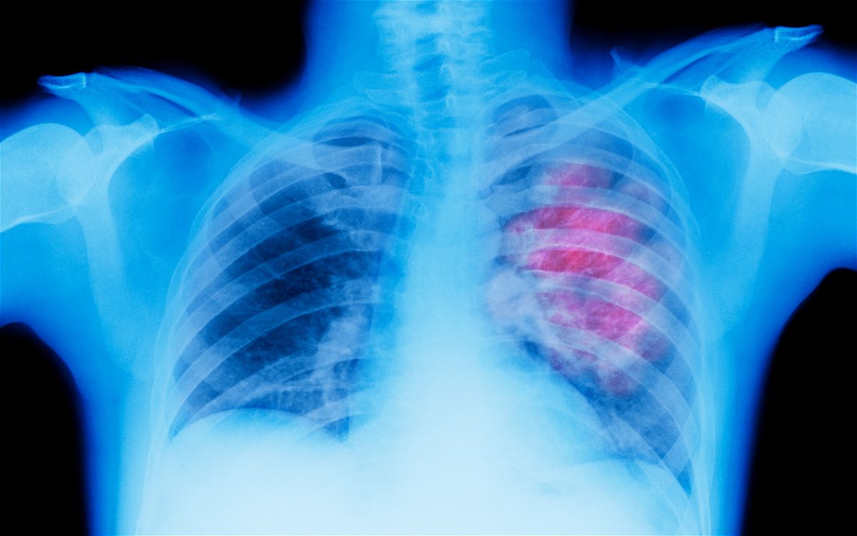 <i>Peter Dazeley/The Image Bank RF/Getty Images</i><br/>Illustration of an X-ray depicting lung cancer