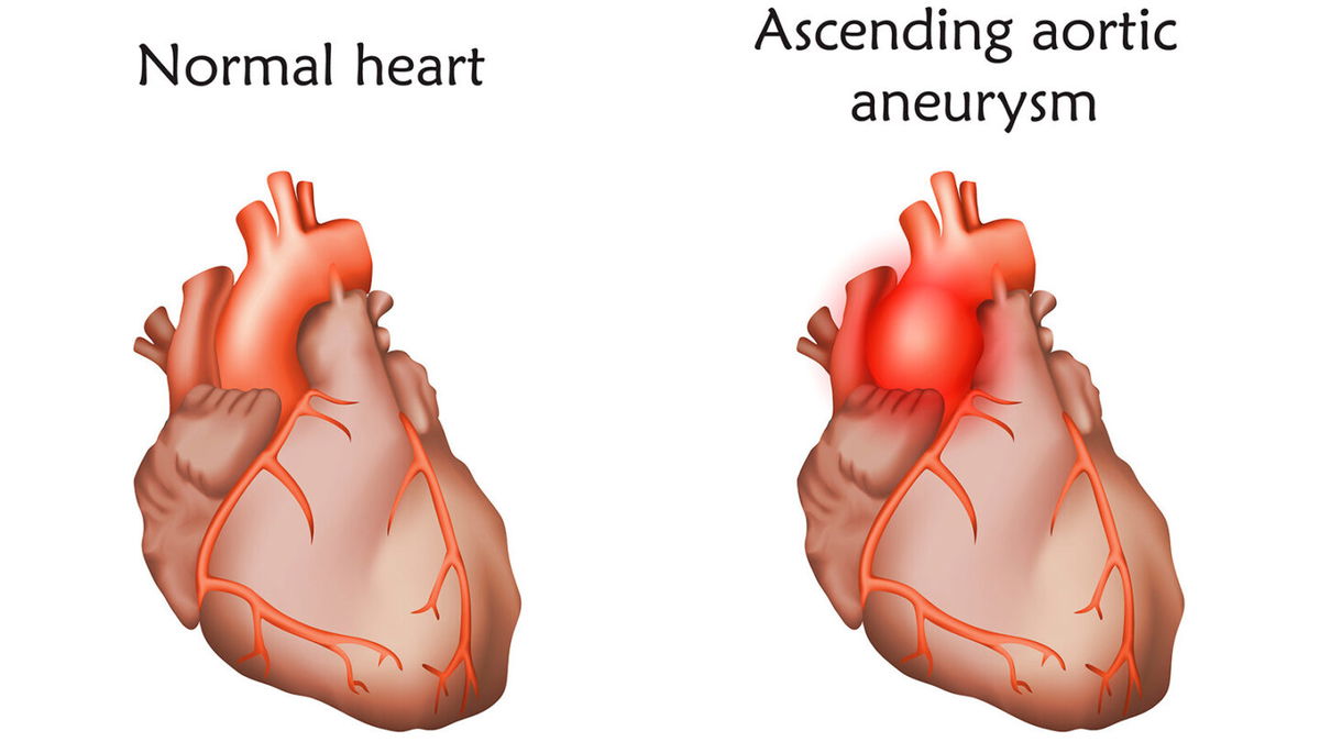 <i>Veronika Zakharova/Science Photo Library RG/Getty Images</i><br/>An aortic aneurysm is a bulge in the aorta