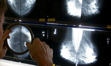 New updates to US Food and Drug Administration mammography regulations require mammography facilities to notify patients about the density of their breasts.