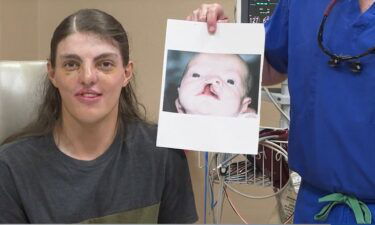 Life-changing cleft lip and palate surgery brings Kian Mattson to Shreveport for the last 18 years.