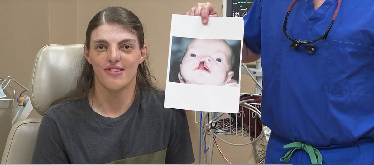 <i></i><br/>Life-changing cleft lip and palate surgery brings Kian Mattson to Shreveport for the last 18 years.