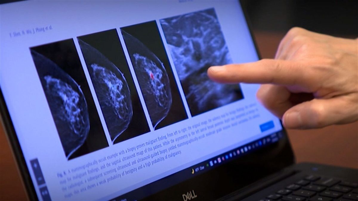 <i>CNN</i><br/>Artificial intelligence found more breast cancers than doctors with years of training and experience and cut doctors’ mammogram reading workload almost in half
