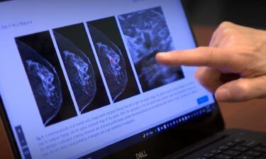 Artificial intelligence found more breast cancers than doctors with years of training and experience and cut doctors’ mammogram reading workload almost in half
