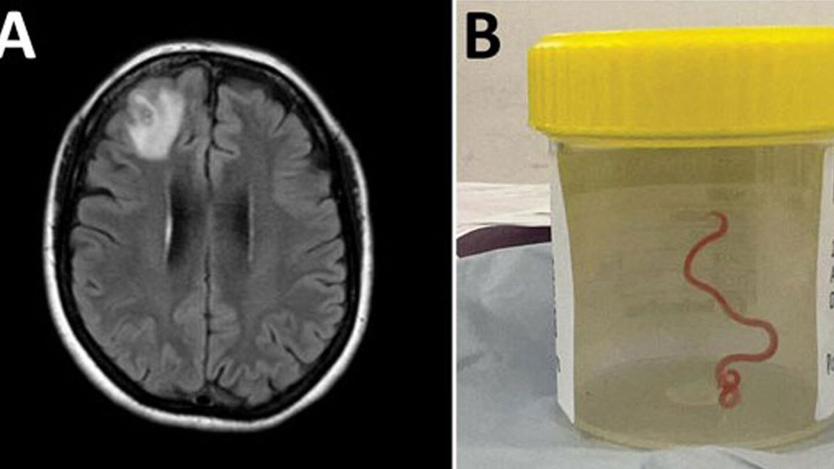 <i>Hossain M/Kennedy KJ/Wilson HL</i><br/>The worm specimen was extracted alive from the woman's brain by surgeons at Canberra Hospital in Australia.