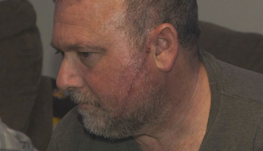 <i>WBZ via CNN Newsource</i><br/>John Baglio's face was slashed by a total stranger who pounced on him as he and his wife took a break outside the hospital while his son was being treated for an emergency heart condition inside
