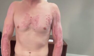 A man who suffered third-degree burns across much of his body after Phoenix officers pinned him face down on the scorching hot pavement has filed a federal lawsuit against the city.